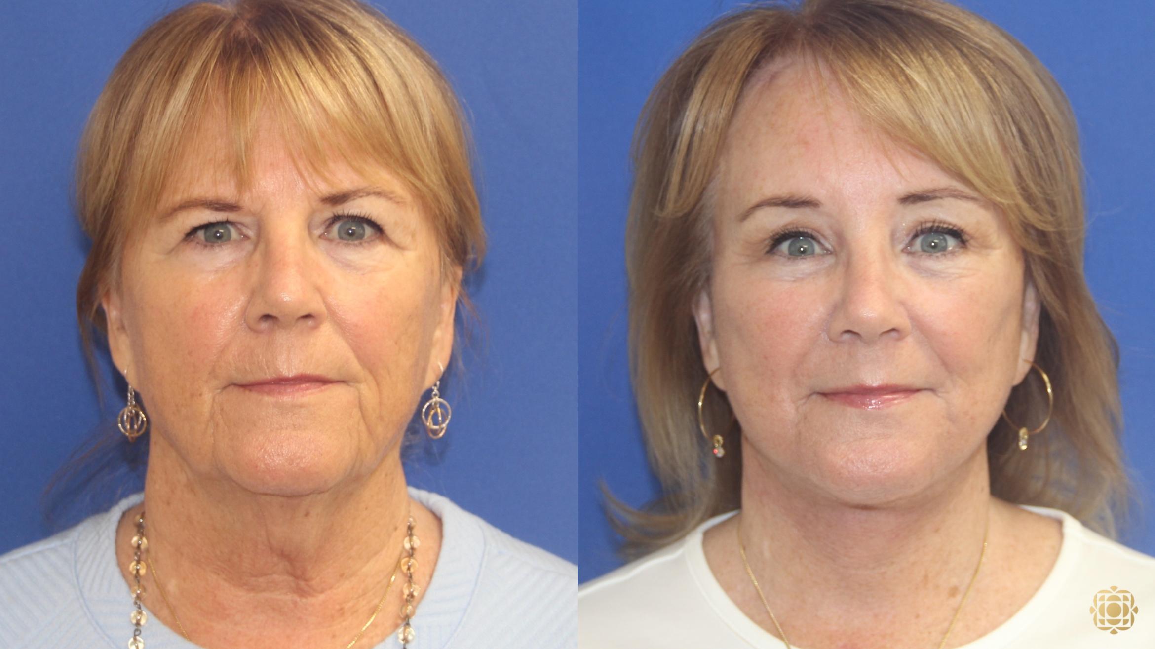 Before & After Face & Neck Lift Case 408 Front View in Newport Beach, CA