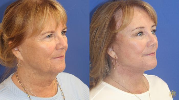Before & After Face & Neck Lift Case 408 Right Oblique View in Newport Beach, CA