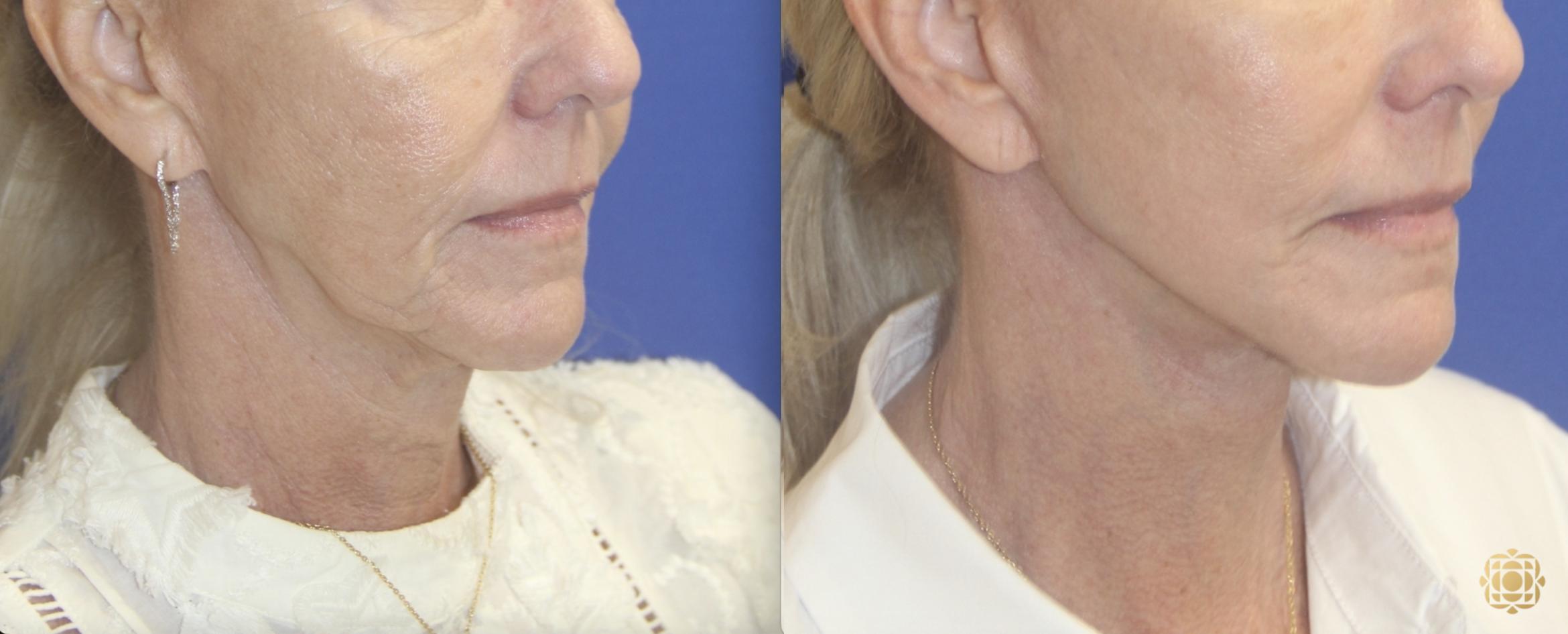 Before & After Face & Neck Lift Case 410 Right Oblique View in Newport Beach, CA