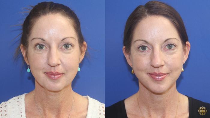 Before & After Face & Neck Lift Case 411 Front View in Newport Beach, CA