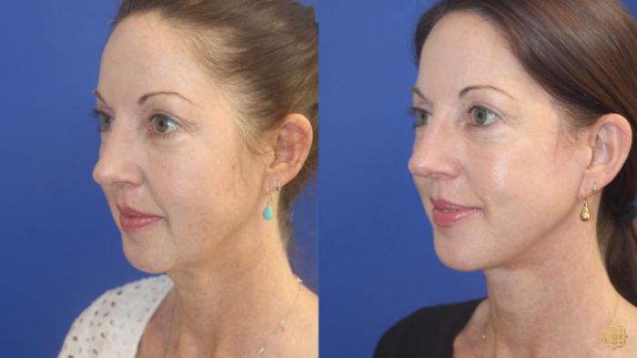 Before & After Face & Neck Lift Case 411 Left Oblique View in Newport Beach, CA