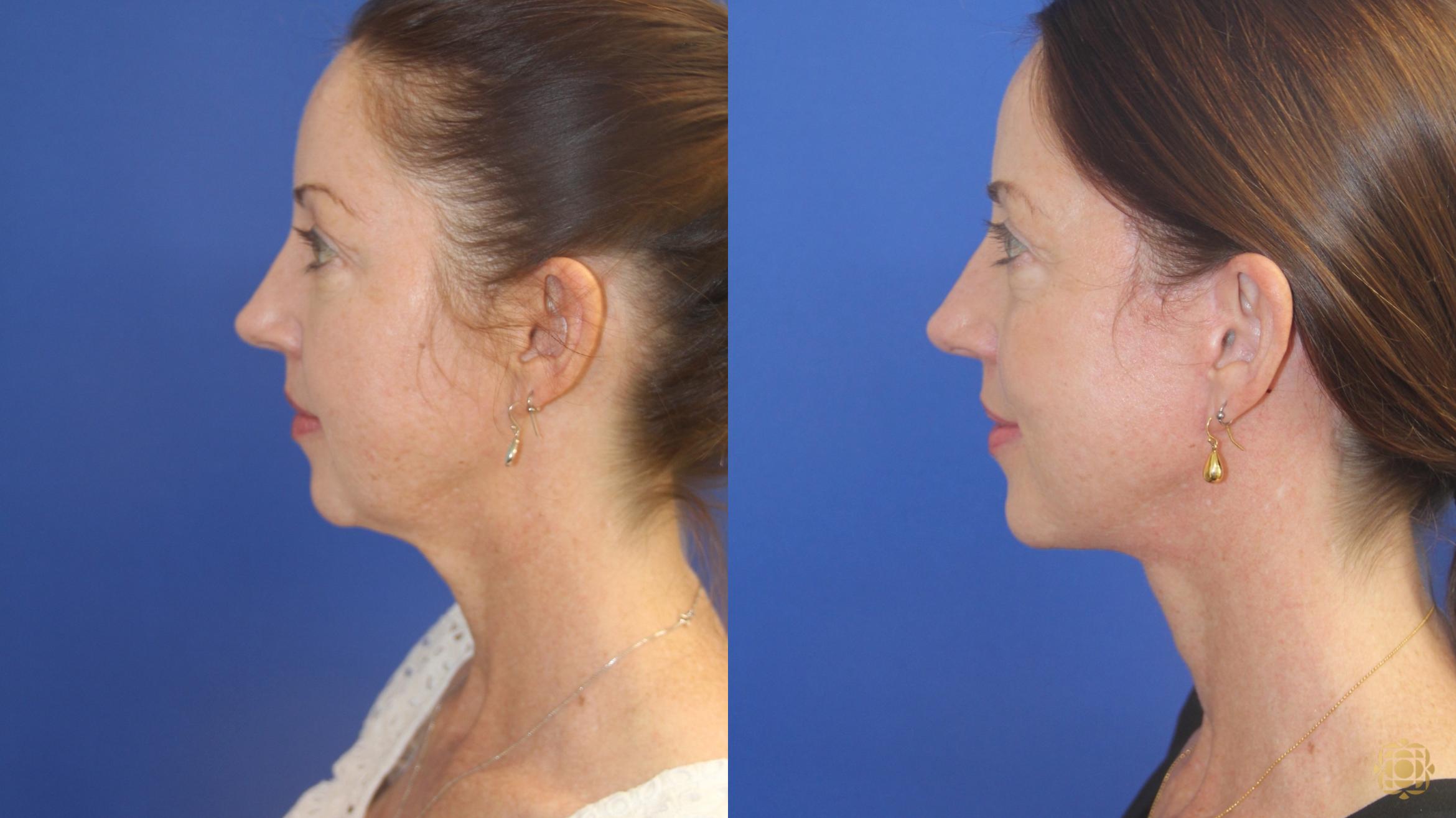 Before & After Face & Neck Lift Case 411 Left Side View in Newport Beach, CA