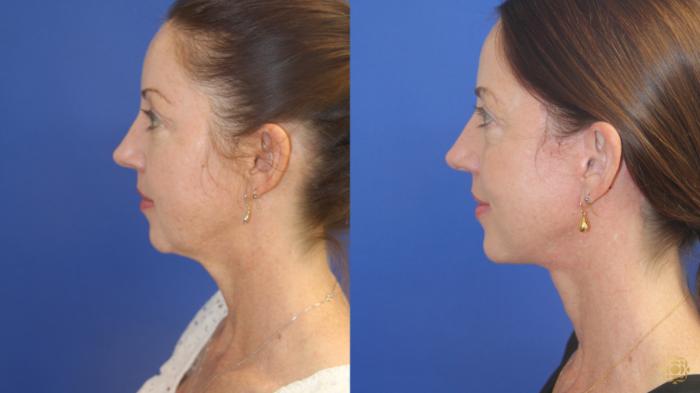 Before & After Face & Neck Lift Case 411 Left Side View in Newport Beach, CA
