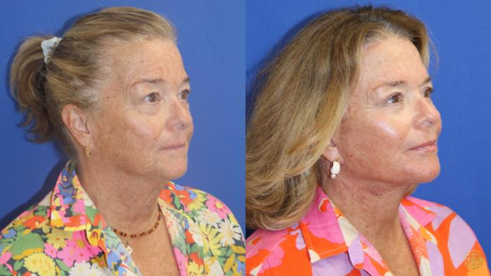 Before & After Face & Neck Lift Case 413 Right Oblique View in Newport Beach, CA