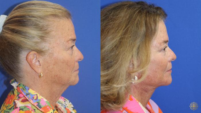 Before & After Face & Neck Lift Case 413 Right Side View in Newport Beach, CA