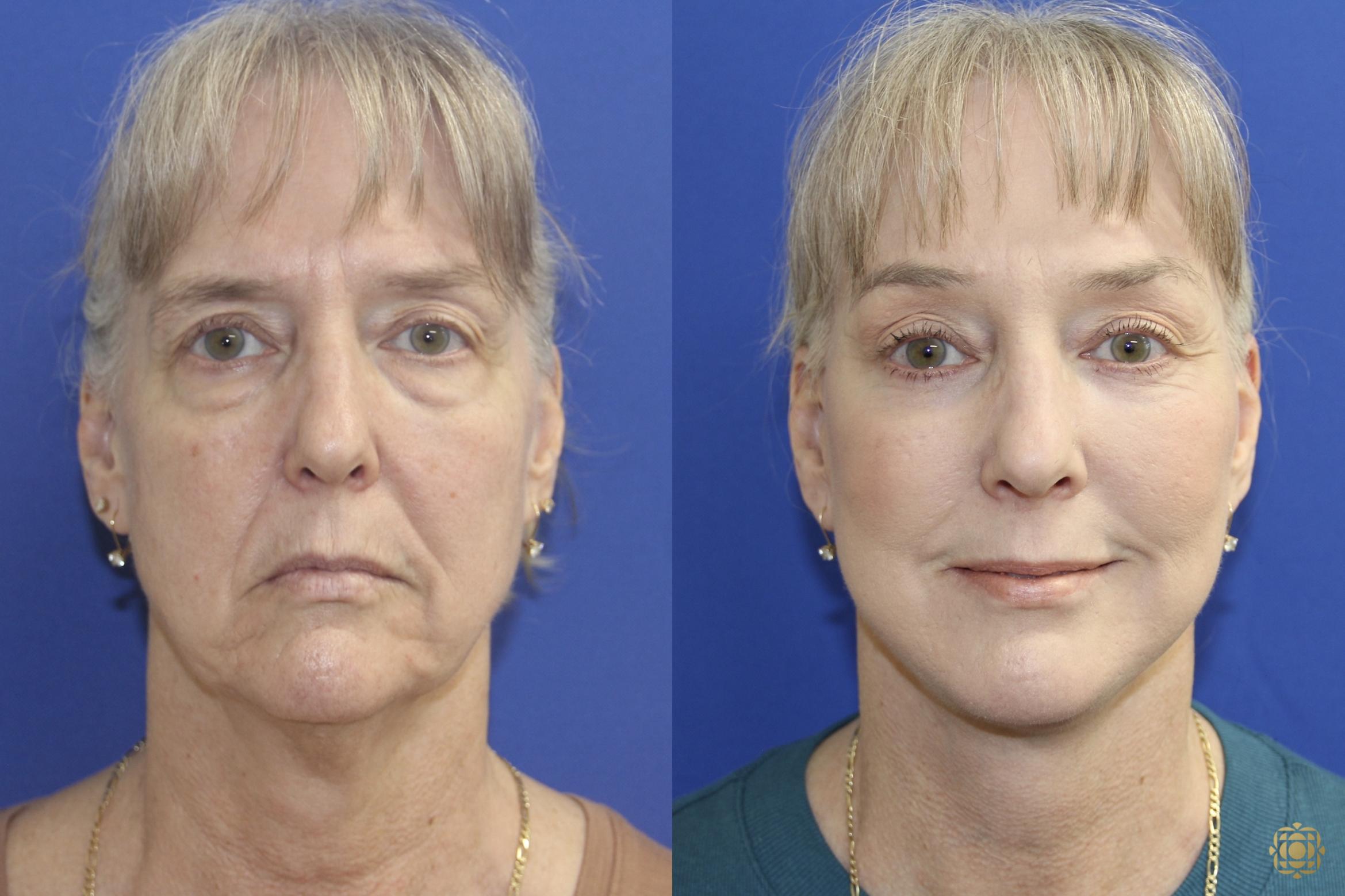 Before & After Face & Neck Lift Case 414 Front View in Newport Beach, CA