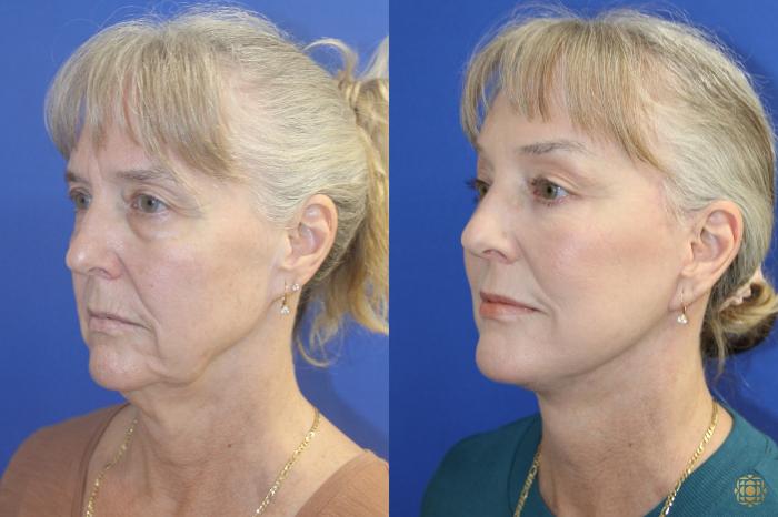 Before & After Face & Neck Lift Case 414 Left Oblique View in Newport Beach, CA