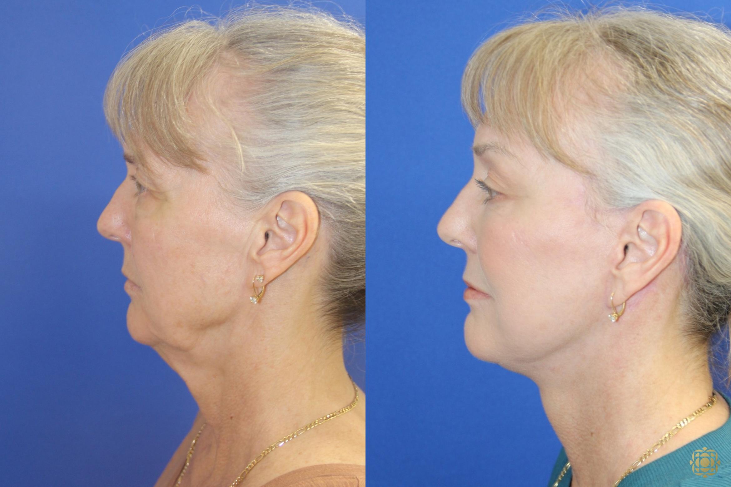 Before & After Face & Neck Lift Case 414 Left Side View in Newport Beach, CA