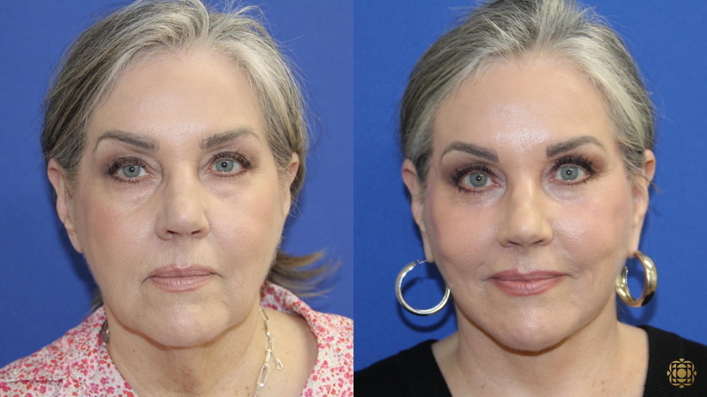 Before & After Face & Neck Lift Case 417 Front View in Newport Beach, CA