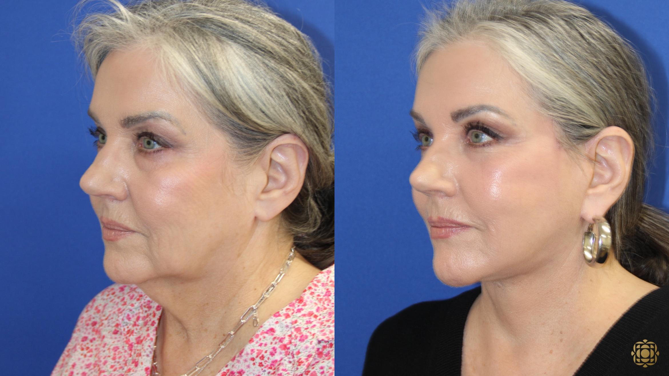 Before & After Face & Neck Lift Case 417 Left Oblique View in Newport Beach, CA