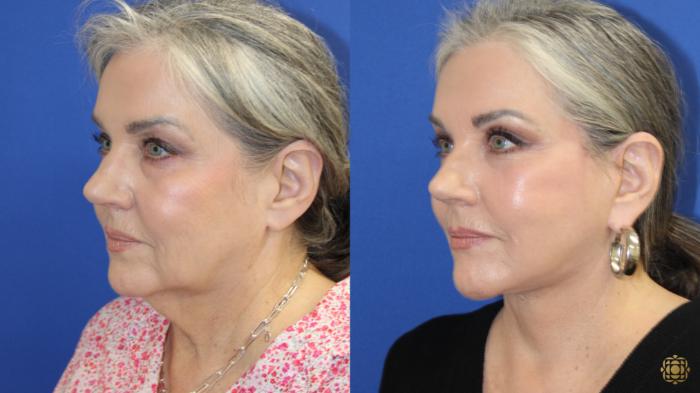 Before & After Face & Neck Lift Case 417 Left Oblique View in Newport Beach, CA