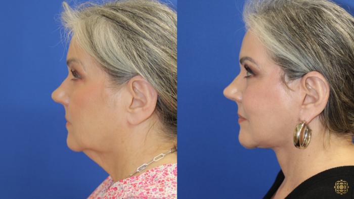Before & After Face & Neck Lift Case 417 Left Side View in Newport Beach, CA
