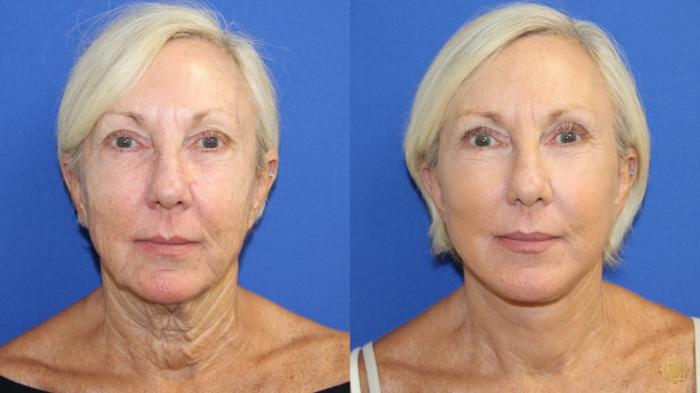 Before & After Face & Neck Lift Case 418 Front View in Newport Beach, CA