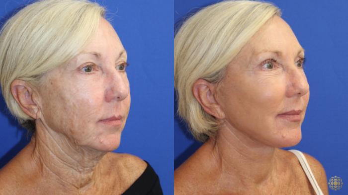Before & After Face & Neck Lift Case 418 Right Oblique View in Newport Beach, CA