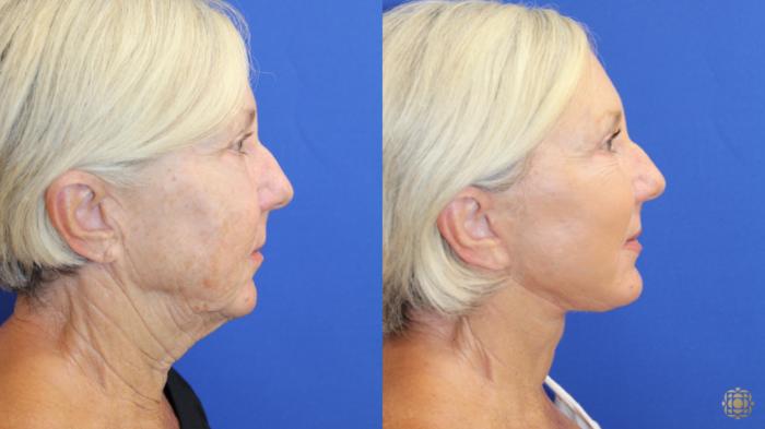 Before & After Face & Neck Lift Case 418 Right Side View in Newport Beach, CA