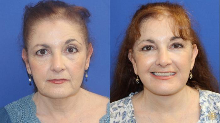 Before & After Brow Lift Case 419 Front View in Newport Beach, CA