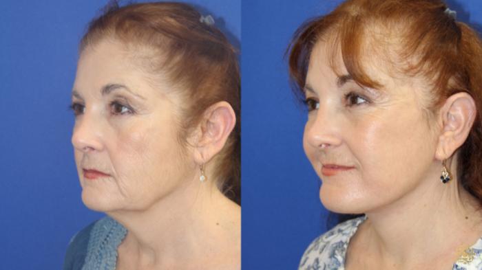 Before & After Face & Neck Lift Case 419 Left Oblique View in Newport Beach, CA