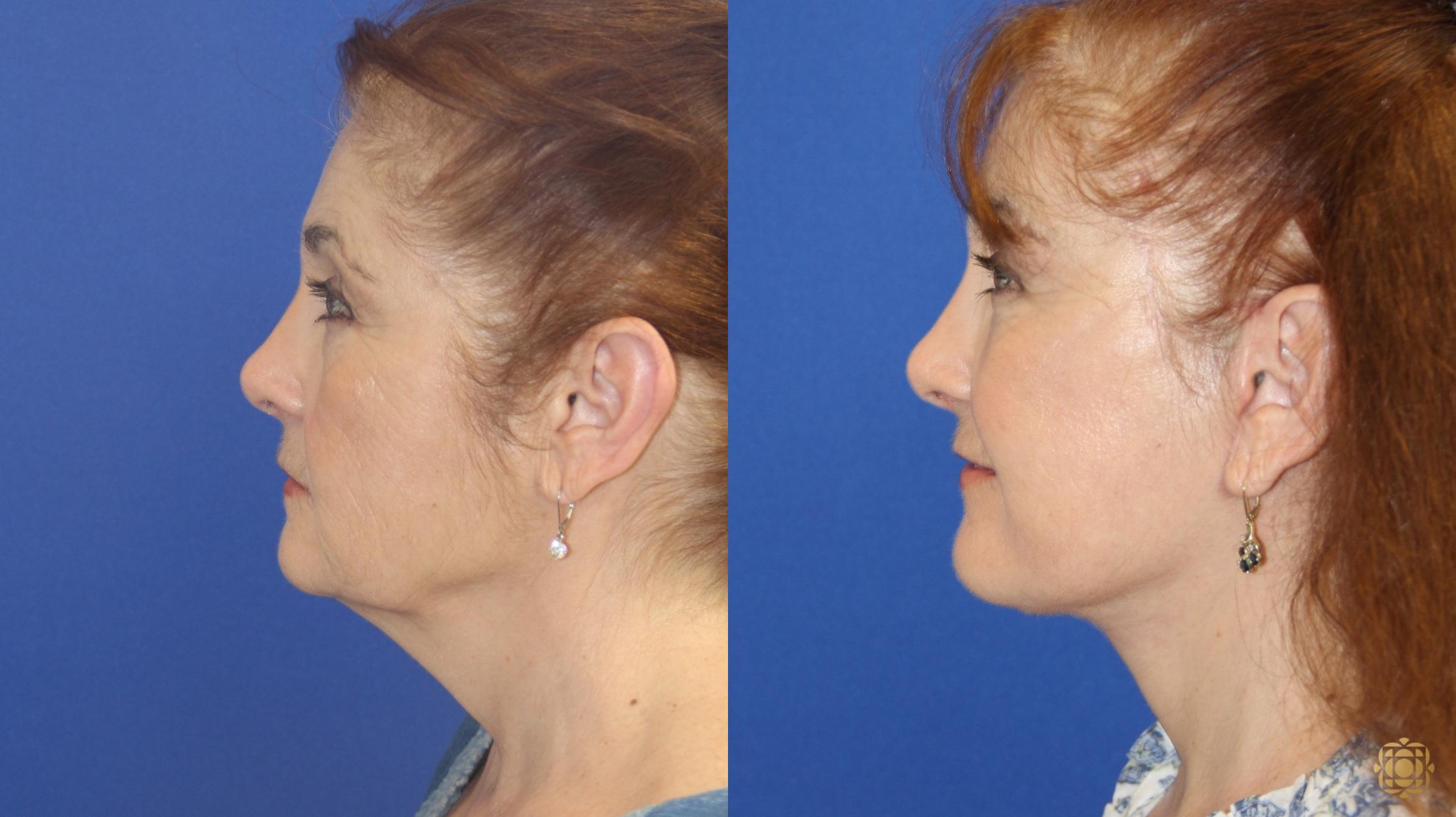 Before & After Face & Neck Lift Case 419 Left Side View in Newport Beach, CA
