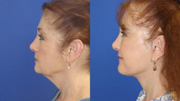 Before & After Face & Neck Lift Case 419 Left Side View in Newport Beach, CA
