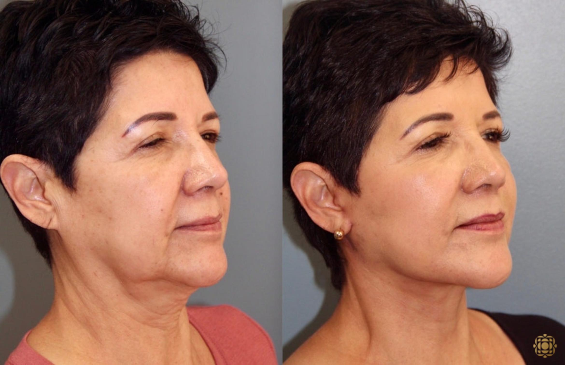 Before & After Face & Neck Lift Case 42 Right Oblique View in Newport Beach, CA