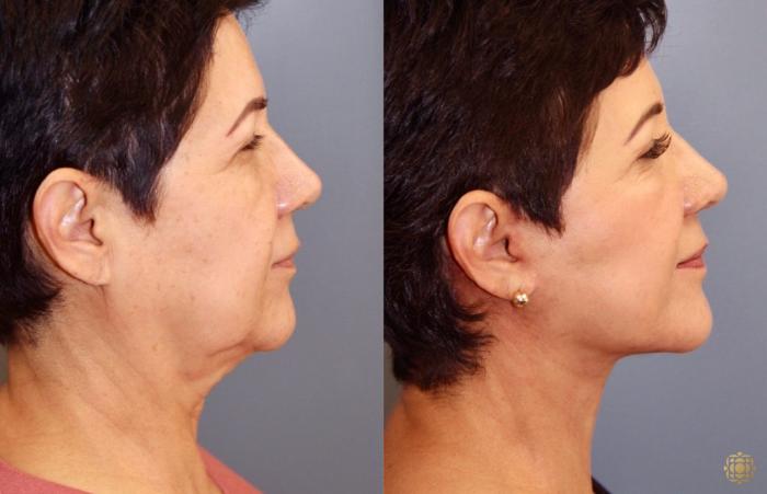 Before & After Face & Neck Lift Case 42 Right Side View in Newport Beach, CA