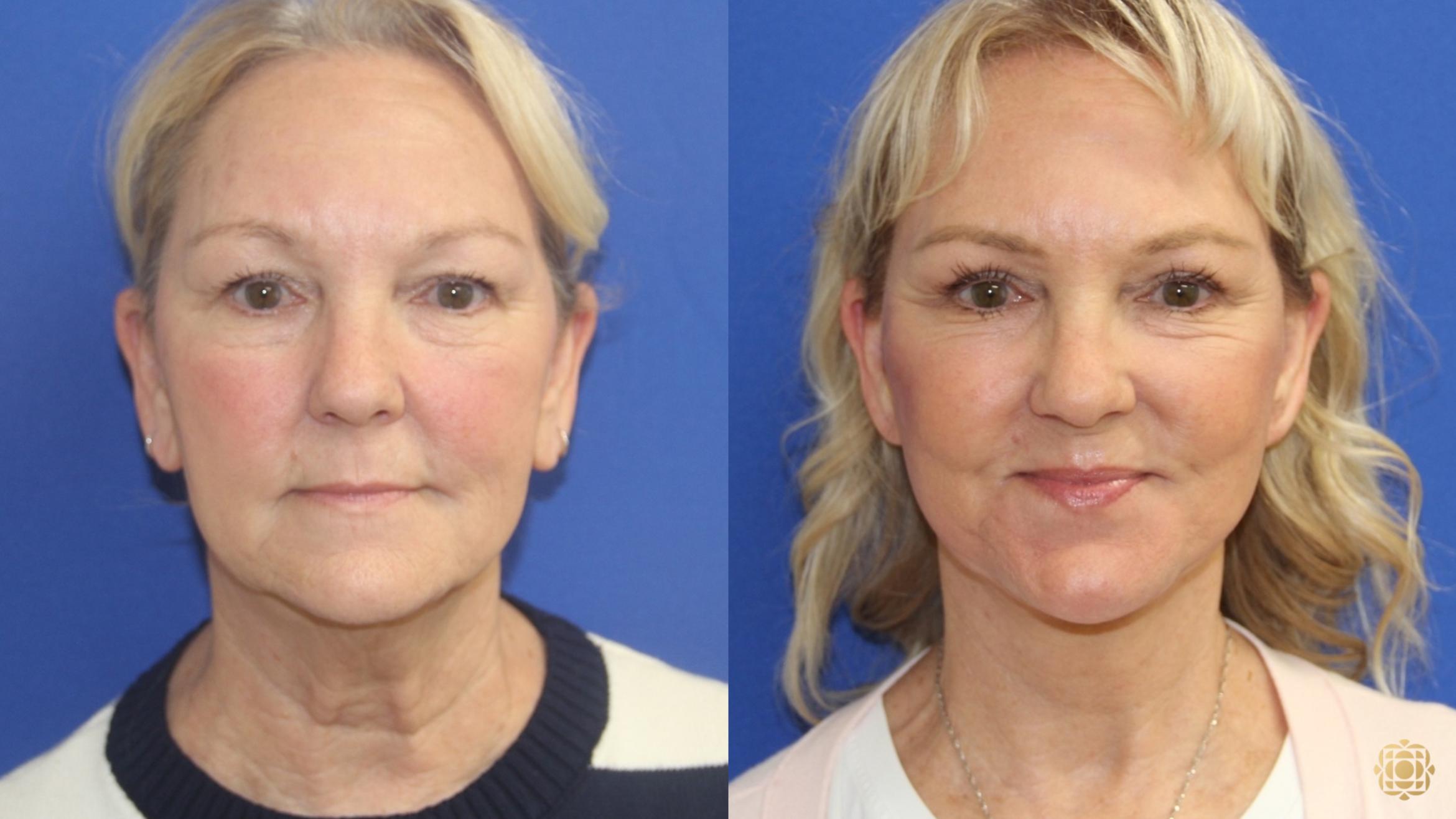 Before & After Face & Neck Lift Case 420 Front View in Newport Beach, CA