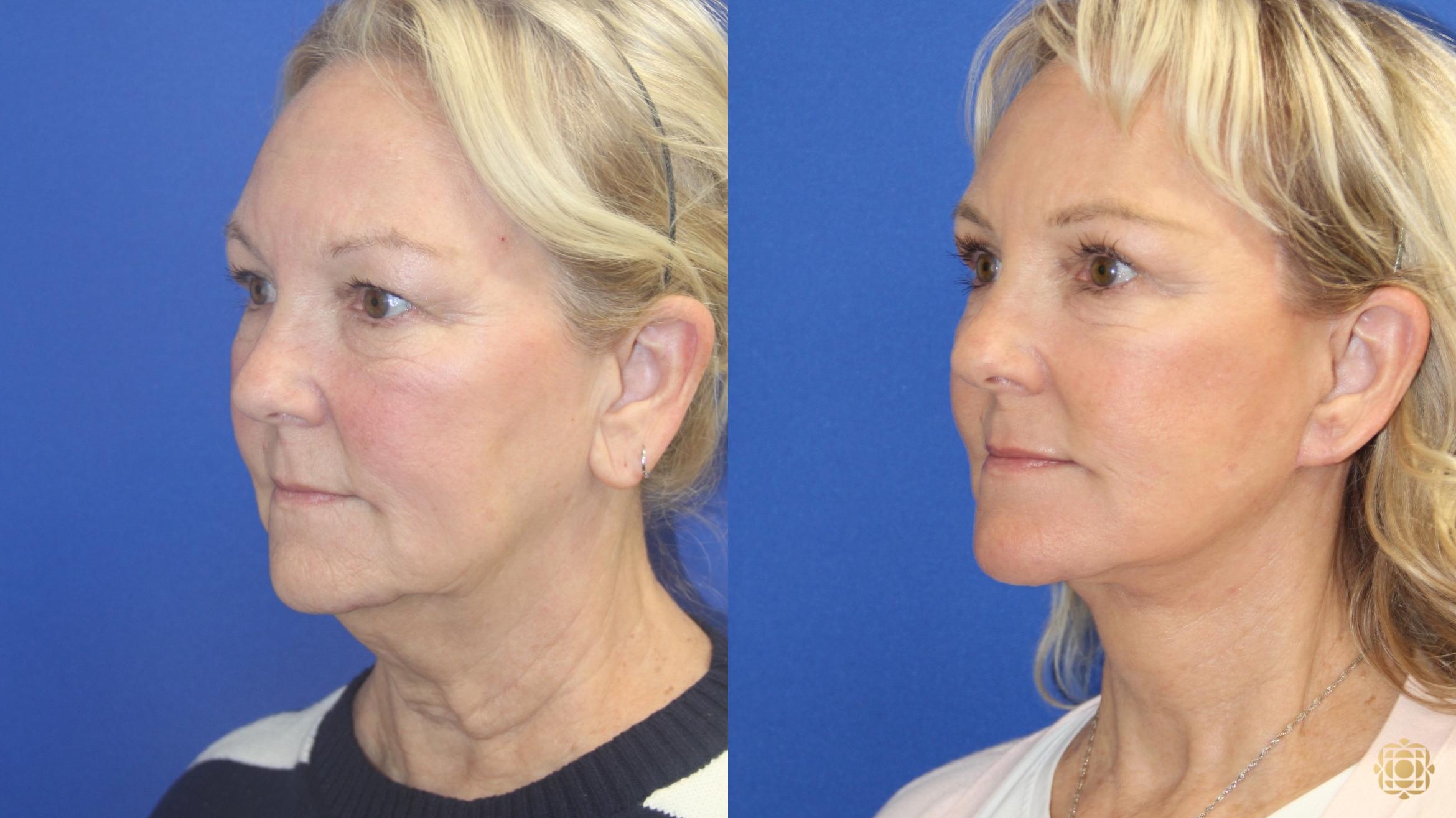 Before & After Face & Neck Lift Case 420 Left Oblique View in Newport Beach, CA