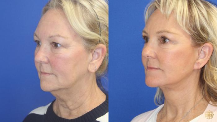 Before & After Face & Neck Lift Case 420 Left Oblique View in Newport Beach, CA