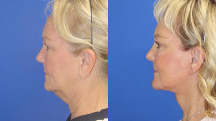 Before & After Face & Neck Lift Case 420 Left Side View in Newport Beach, CA