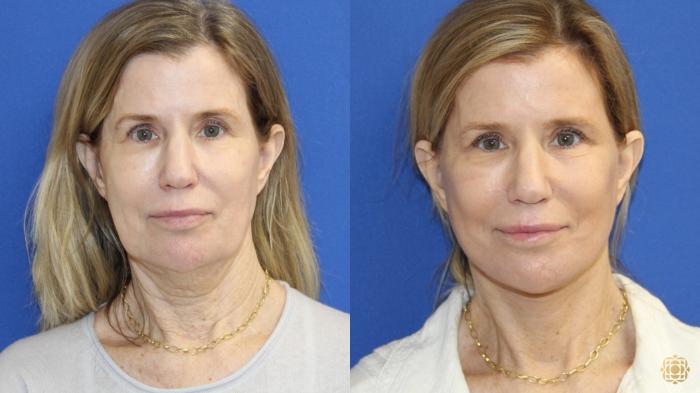 Before & After Face & Neck Lift Case 421 Front View in Newport Beach, CA