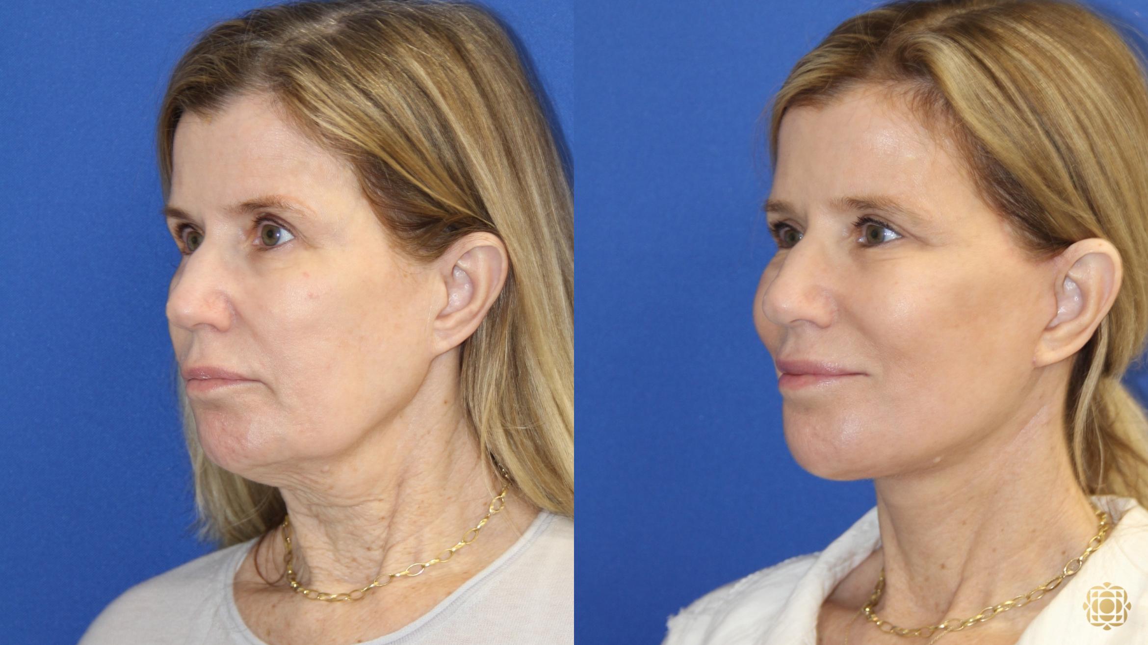 Before & After Face & Neck Lift Case 421 Left Oblique View in Newport Beach, CA
