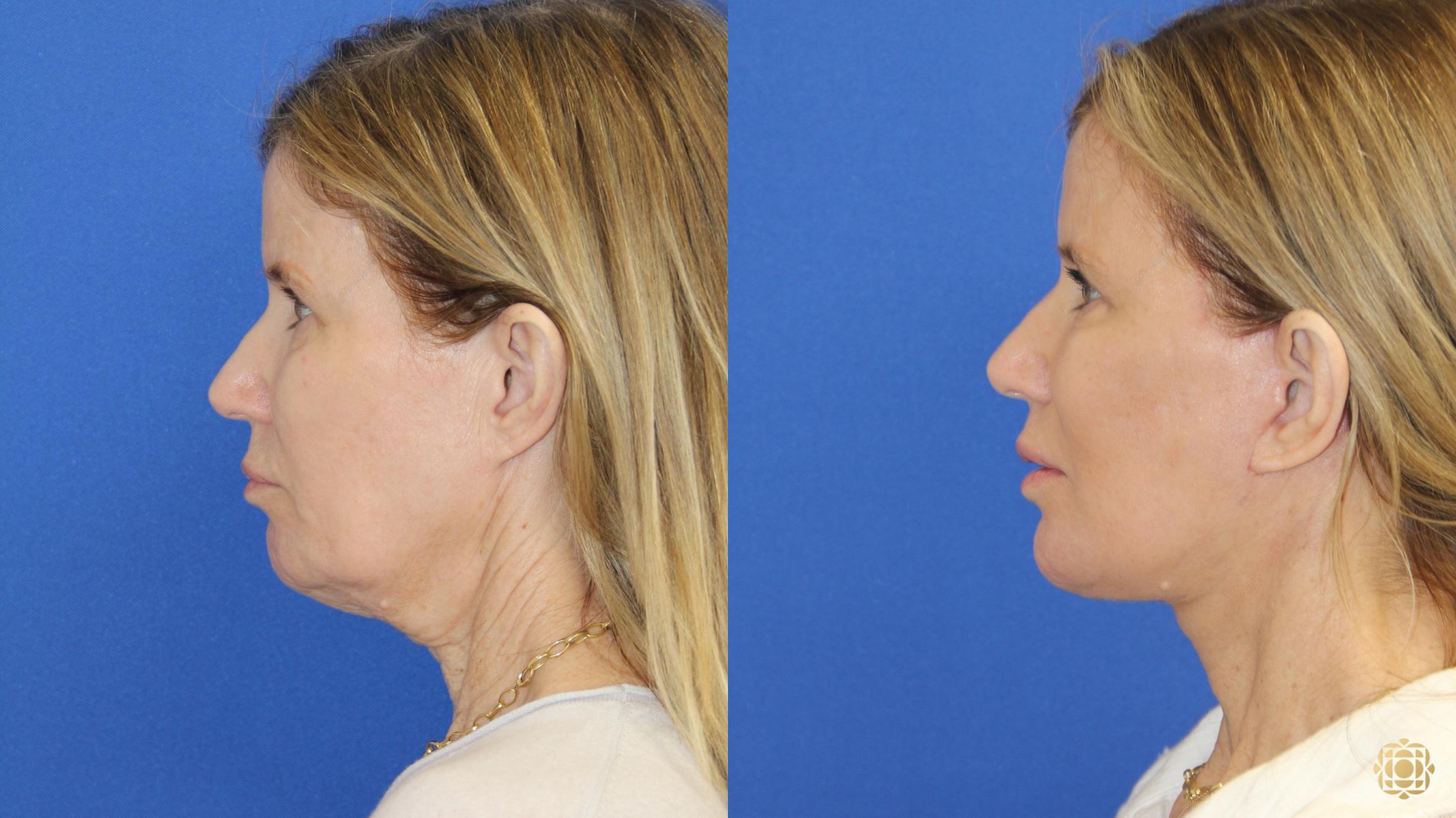 Before & After Face & Neck Lift Case 421 Left Side View in Newport Beach, CA