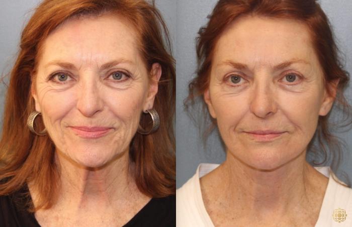 Before & After Face & Neck Lift Case 45 Front View in Newport Beach, CA