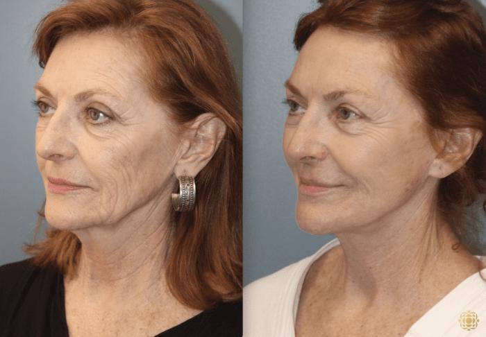 Before & After Face & Neck Lift Case 45 Left Oblique View in Newport Beach, CA