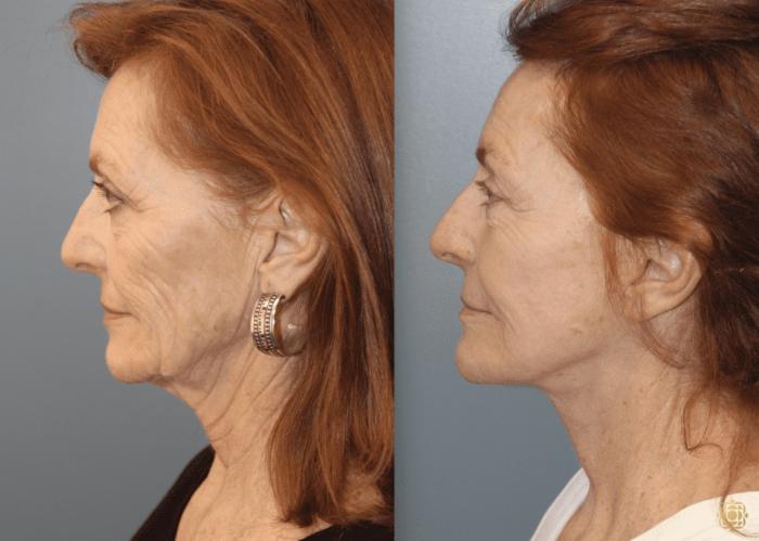 Before & After Face & Neck Lift Case 45 Left Side View in Newport Beach, CA