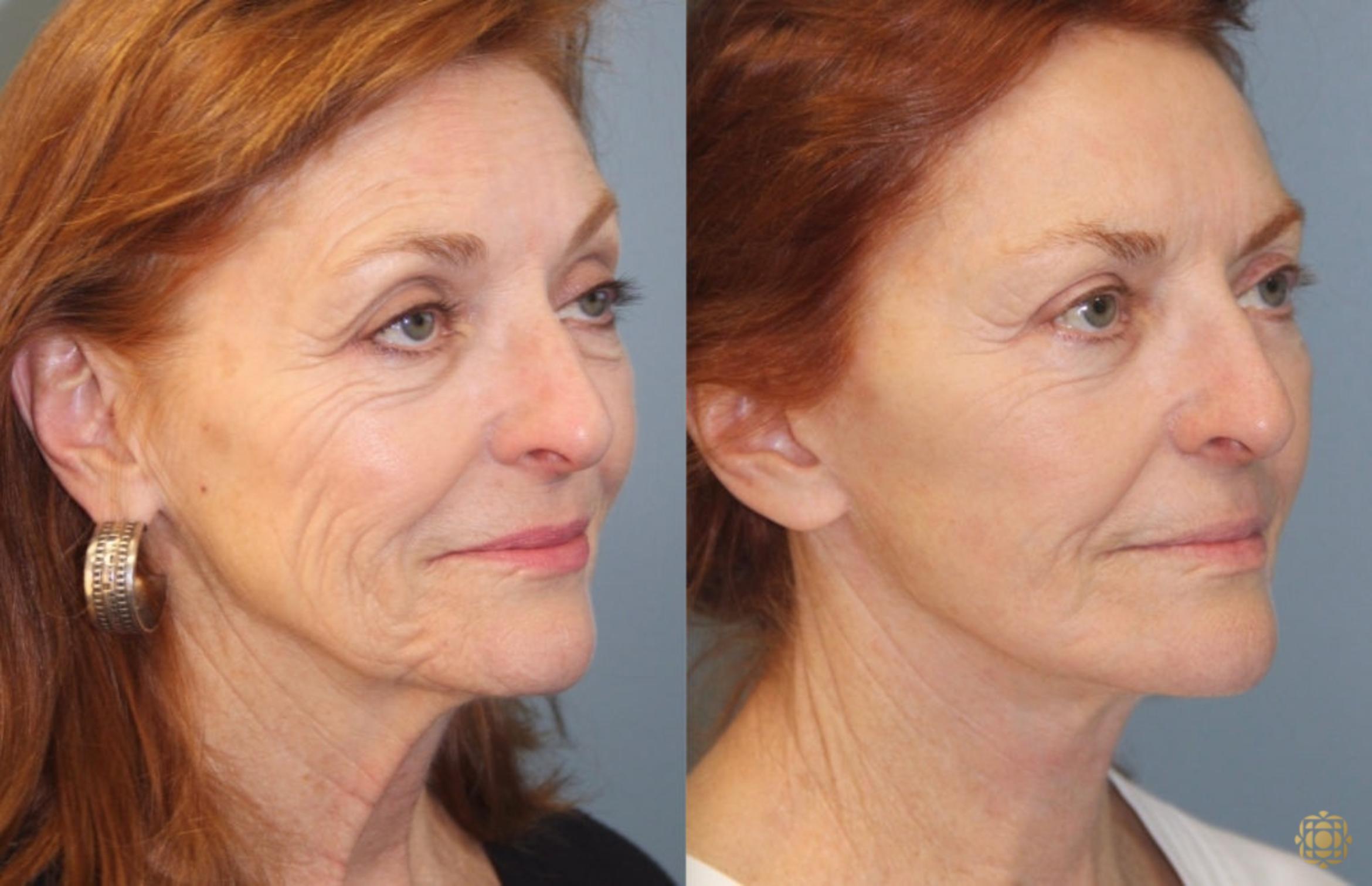 Before & After Face & Neck Lift Case 45 Right Oblique View in Newport Beach, CA