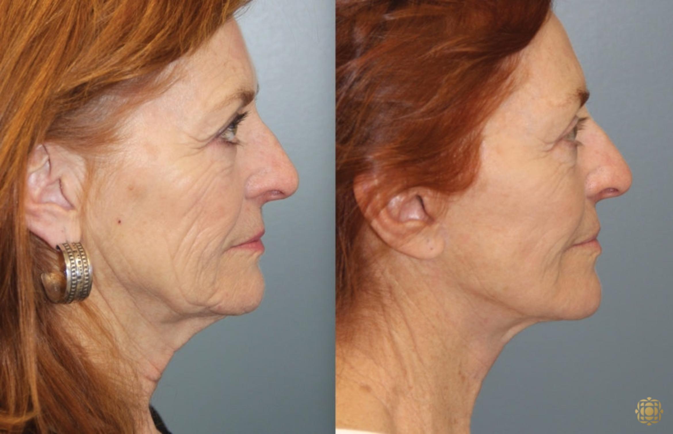 Before & After Face & Neck Lift Case 45 Right Side View in Newport Beach, CA