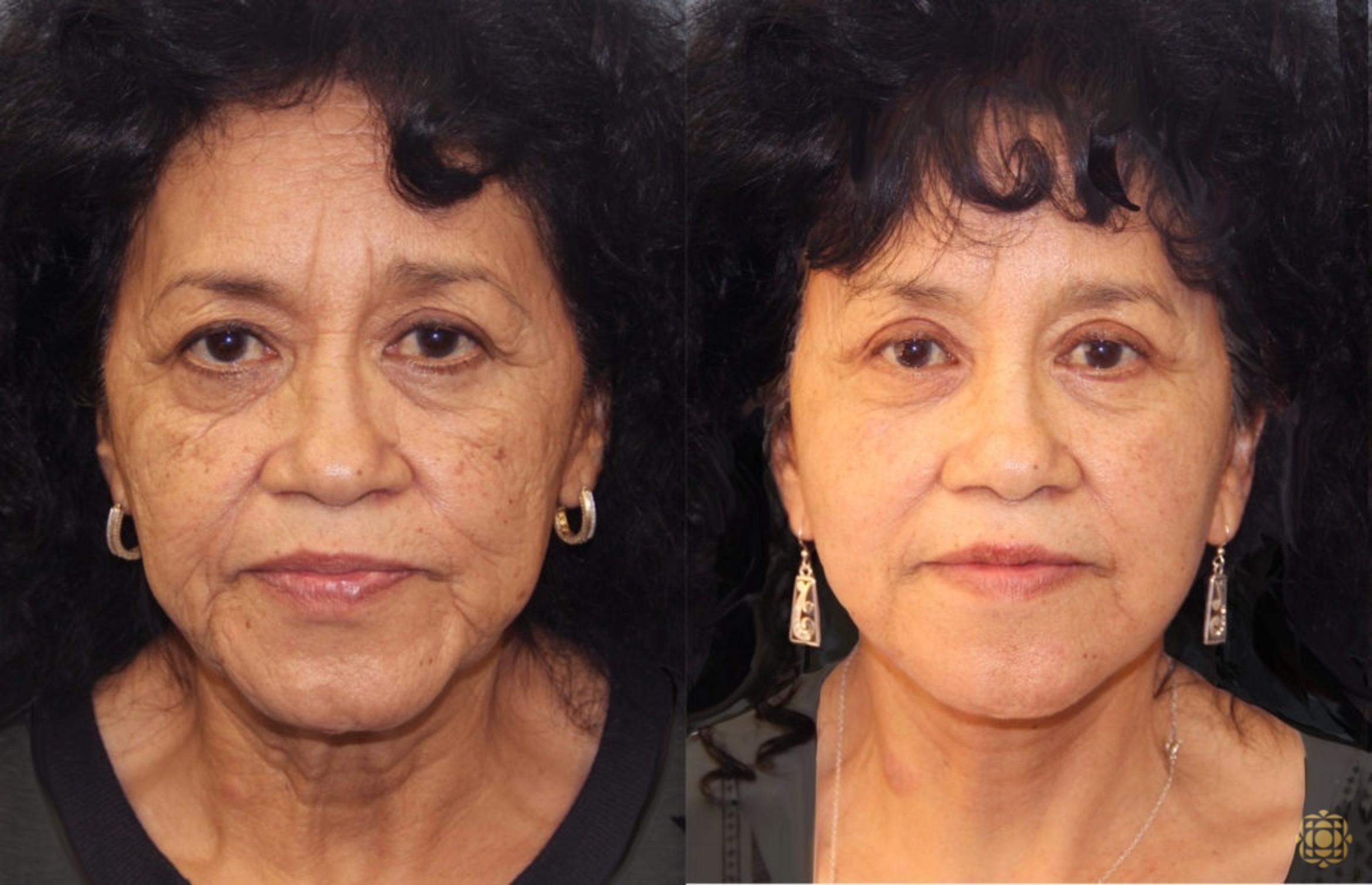 Before & After Face & Neck Lift Case 48 Front View in Newport Beach, CA