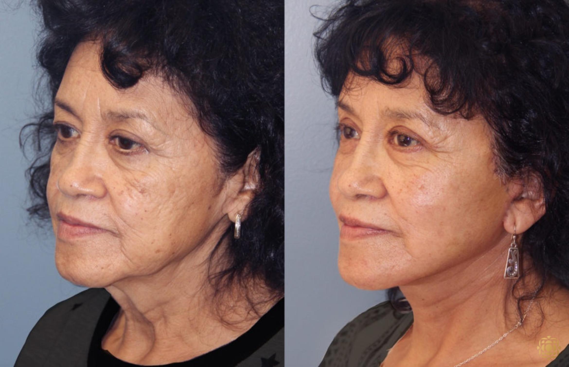 Before & After Face & Neck Lift Case 48 Right Oblique View in Newport Beach, CA