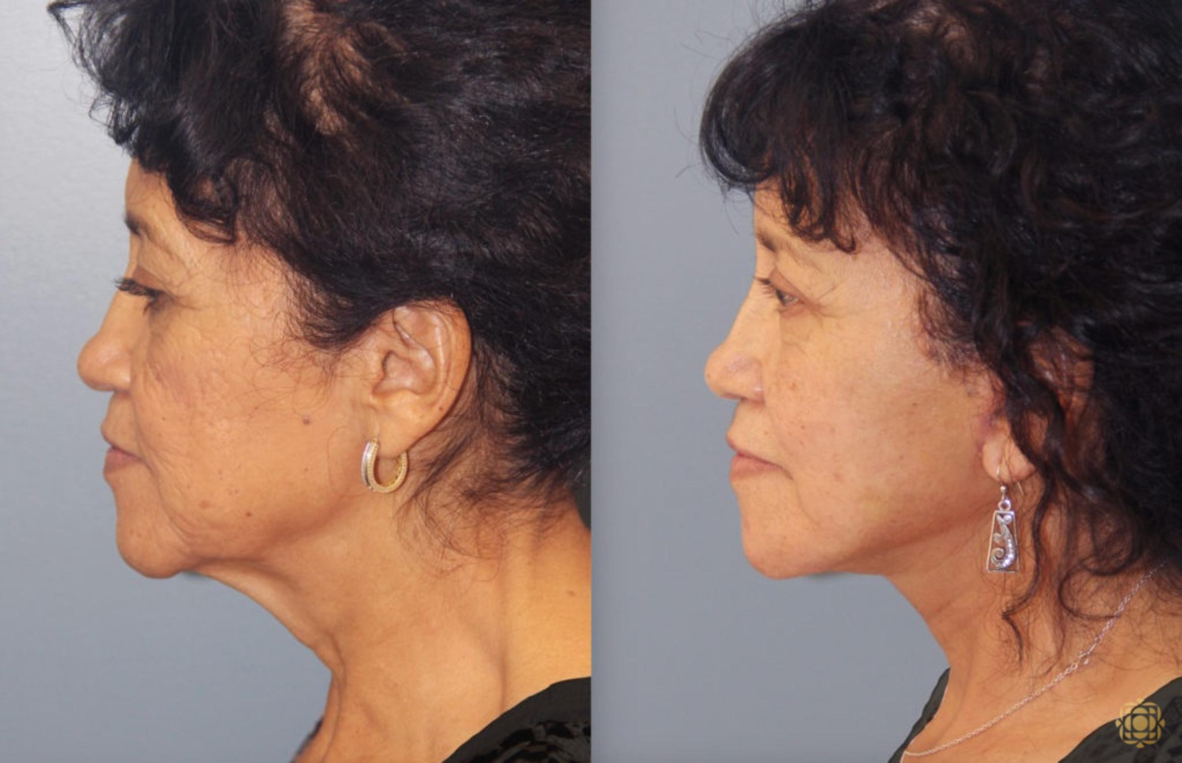 Before & After Face & Neck Lift Case 48 Right Side View in Newport Beach, CA