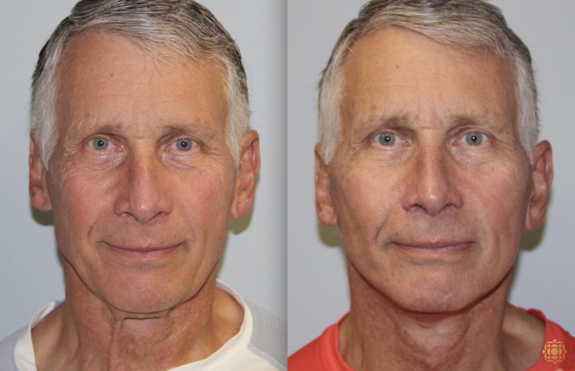 Before & After Face & Neck Lift Case 51 Front View in Newport Beach, CA