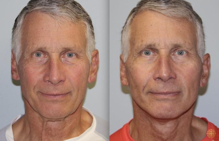 Before & After Face & Neck Lift Case 51 Front View in Newport Beach, CA