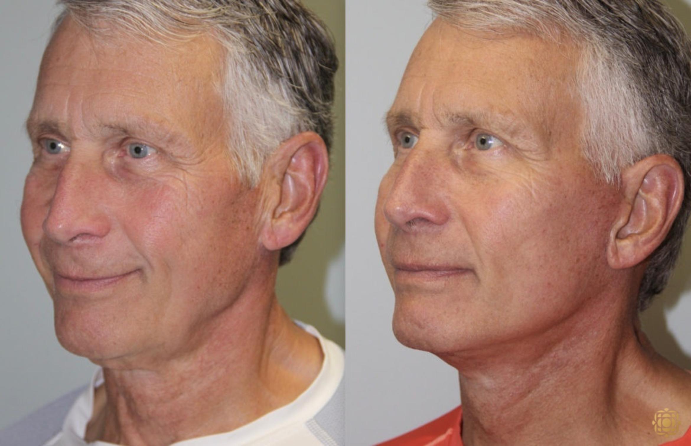 Before & After Face & Neck Lift Case 51 Left Oblique View in Newport Beach, CA