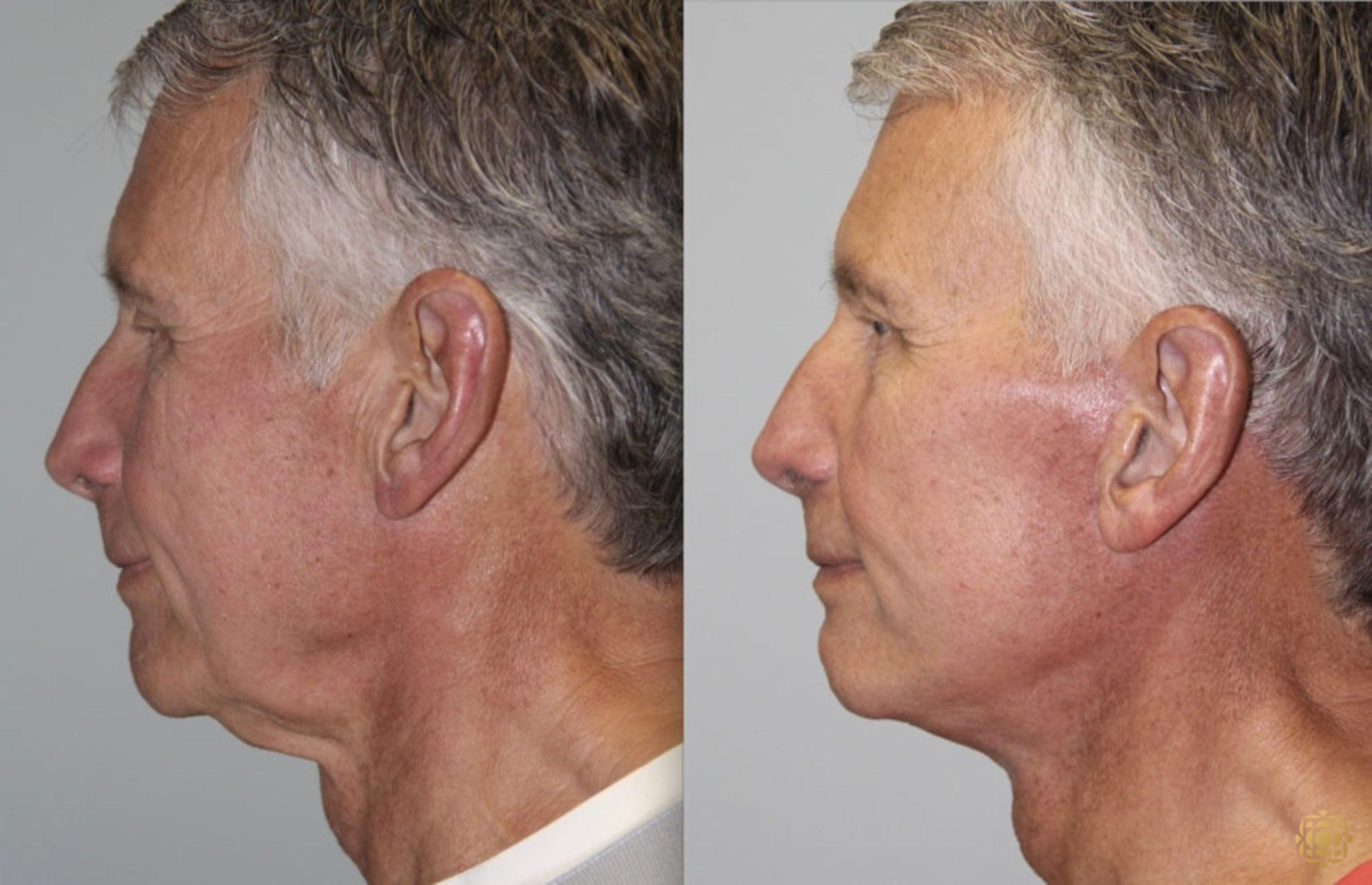 Before & After Face & Neck Lift Case 51 Left Side View in Newport Beach, CA