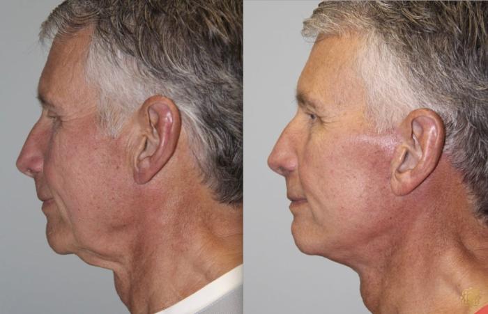 Before & After Face & Neck Lift Case 51 Left Side View in Newport Beach, CA