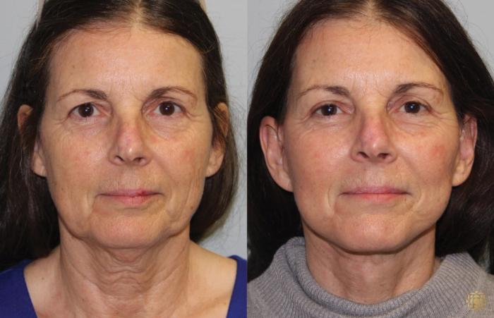 Before & After Face & Neck Lift Case 54 Front View in Newport Beach, CA