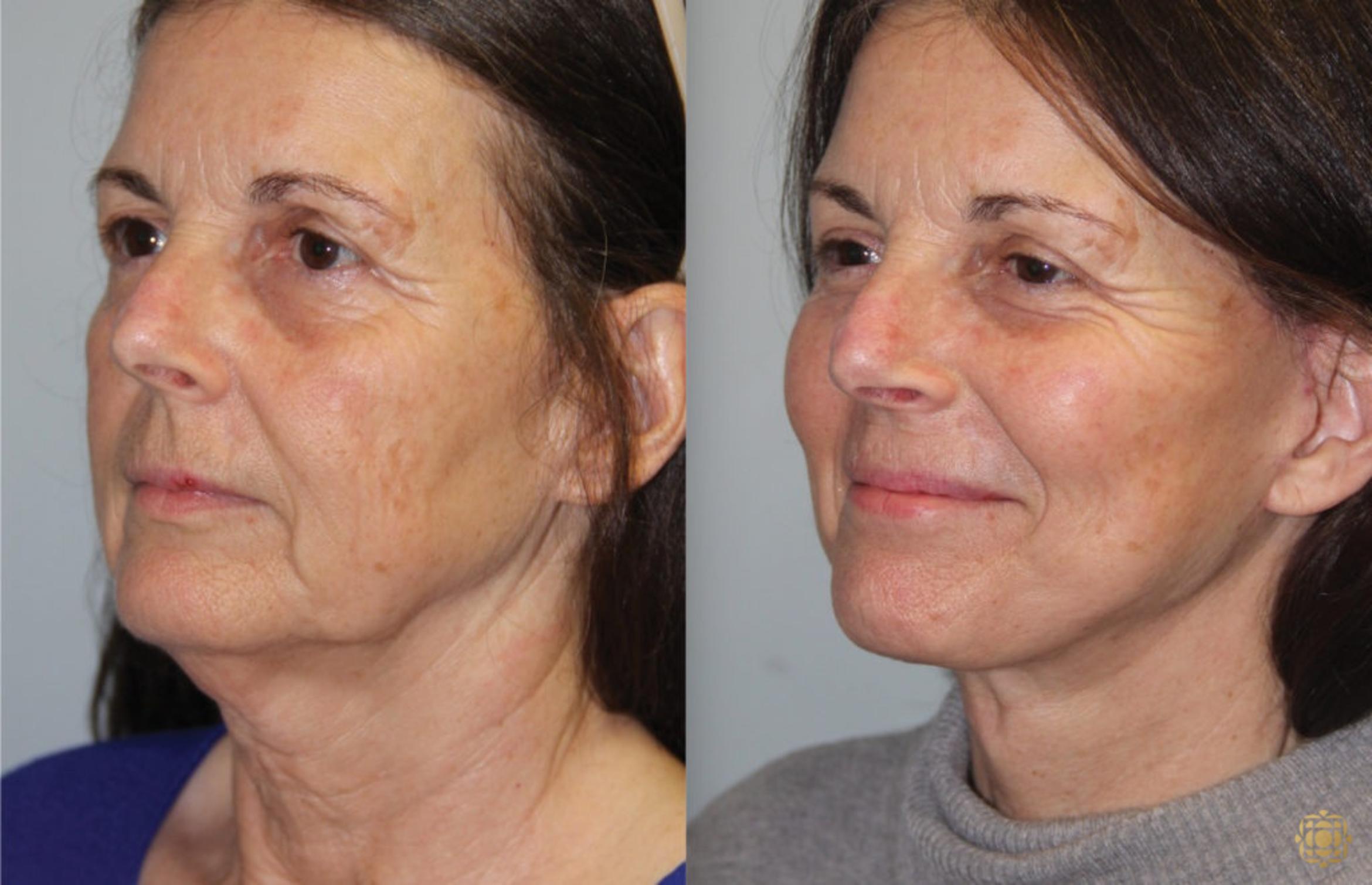 Before & After Face & Neck Lift Case 54 Left Oblique View in Newport Beach, CA