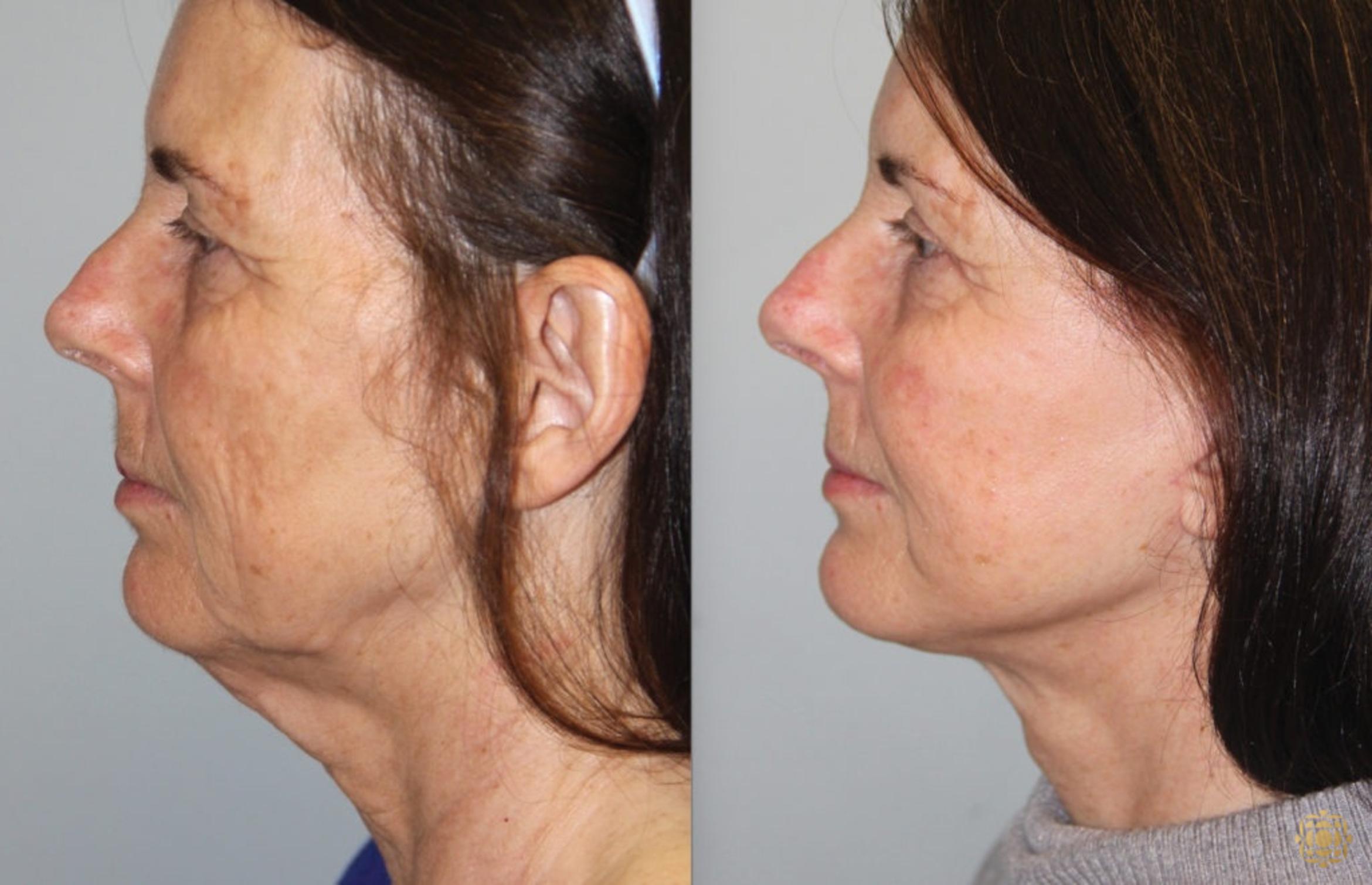 Before & After Face & Neck Lift Case 54 Left Side View in Newport Beach, CA