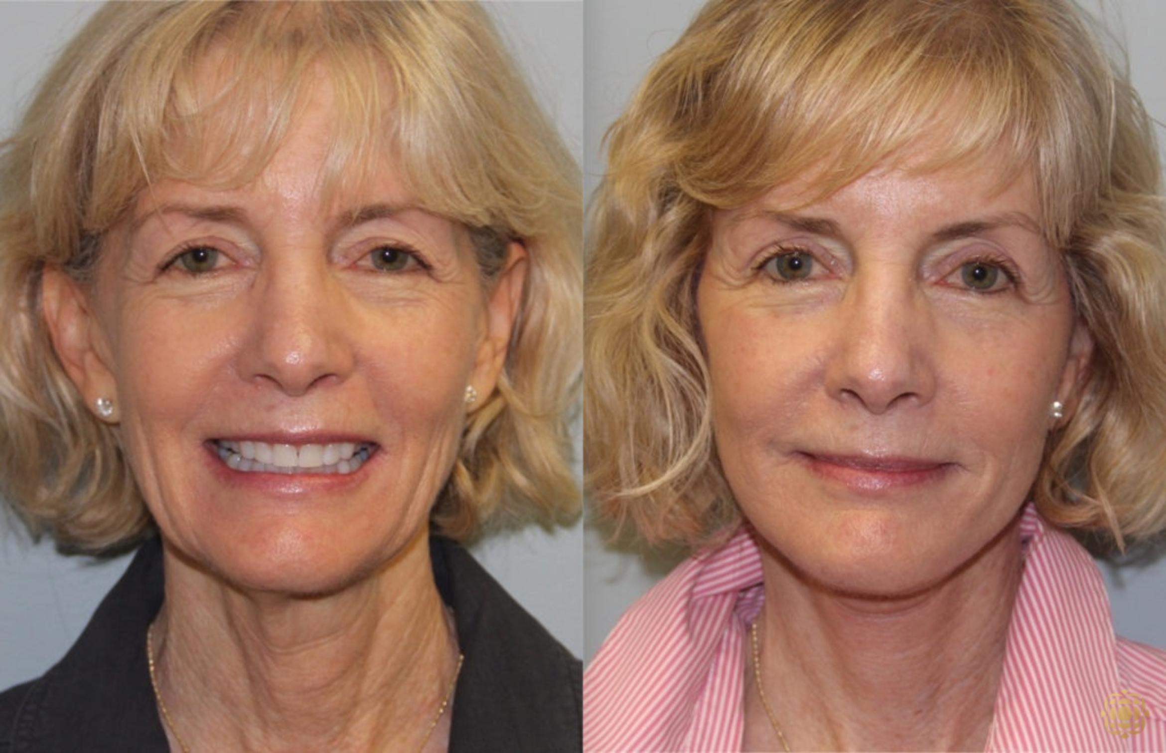 Before & After Face & Neck Lift Case 57 Front View in Newport Beach, CA