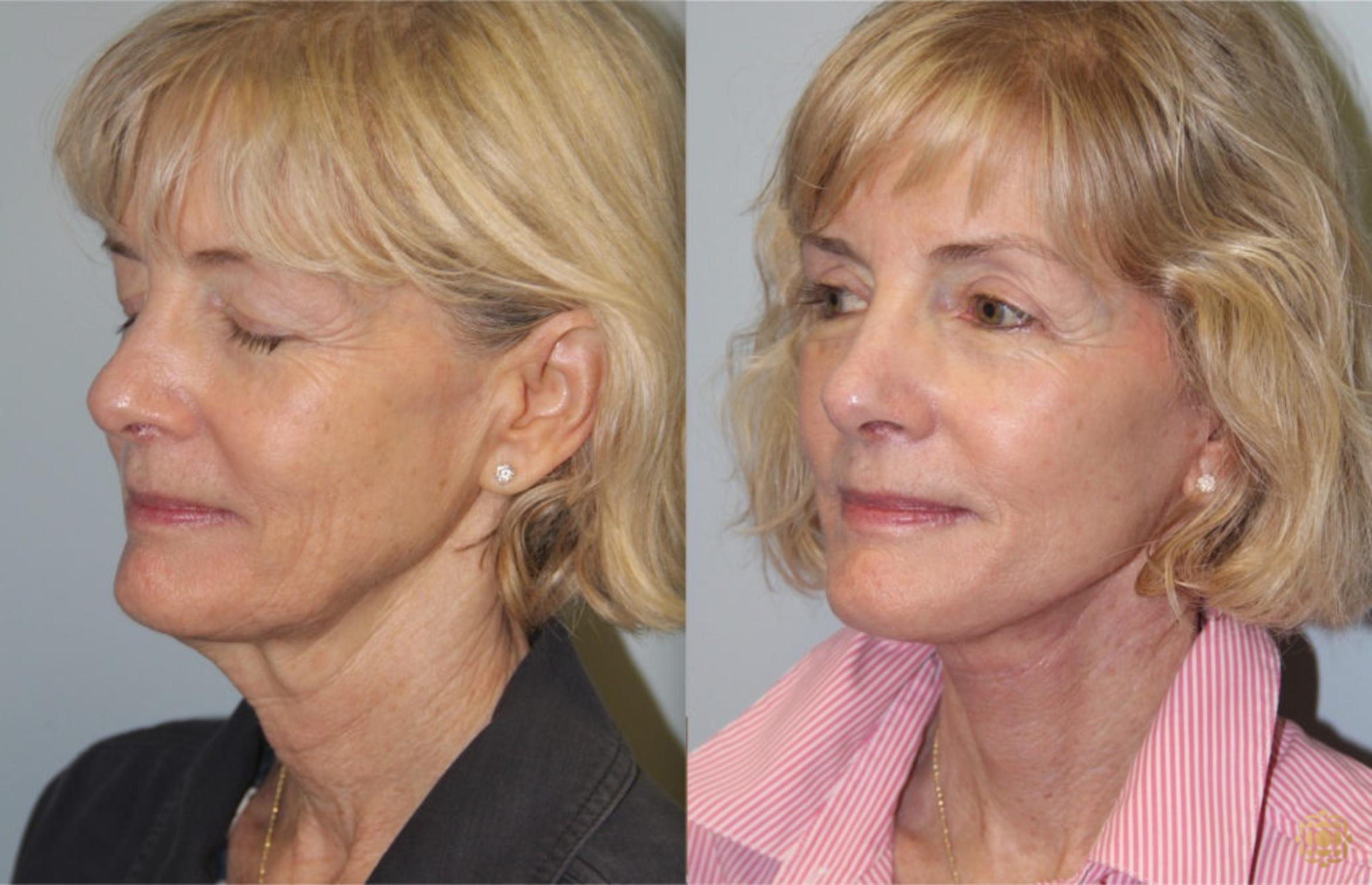 Before & After Face & Neck Lift Case 57 Left Oblique View in Newport Beach, CA